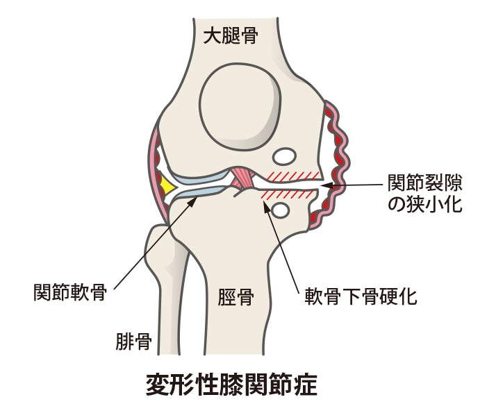 関節裂隙の矮小化、軟骨下骨硬化