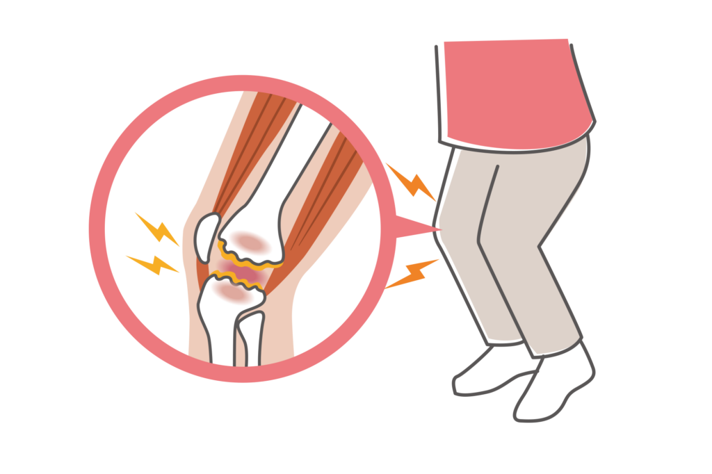 JOINT PAIN（関節の痛み） 病期によって変化する変形性関節症の疼痛要因：関節包由来→+軟骨下骨